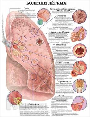 Травмы и болезни организма. Медицинский плакат 6